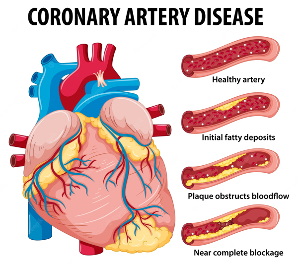 冠状动脉心脏病形成因素示意图。
