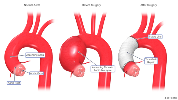 图左起为正常主动脉、手术前主动脉及手术后主动脉。
