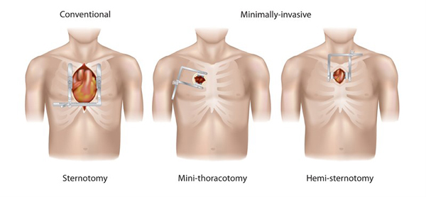 图左起为常规胸部切开术和属于微创心脏手术的小伤口开胸术及半胸肌切开术。
