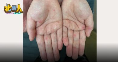 手足口症病例激增　 槟一周增1085宗 42感染群